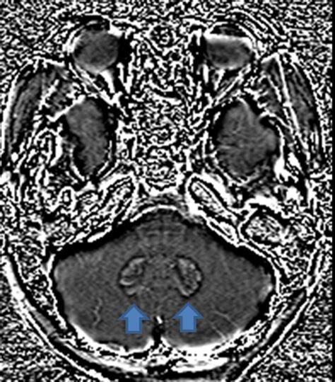 Phase image of the dentate nucleus. | Download Scientific Diagram