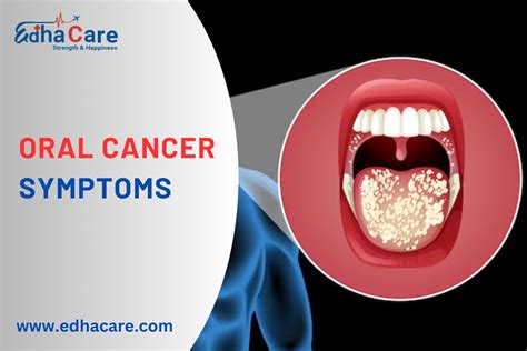 Recognize Oral Cancer Symptoms - A Guide By EdhaCare