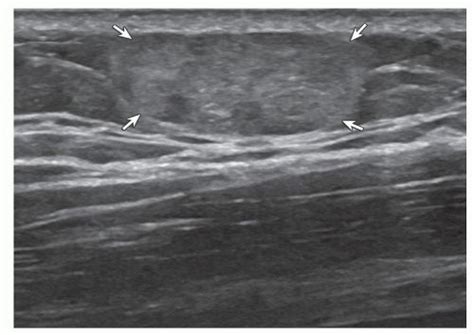 Angiolipoma. Ultrasound image shows well-defined hyperechoic ...