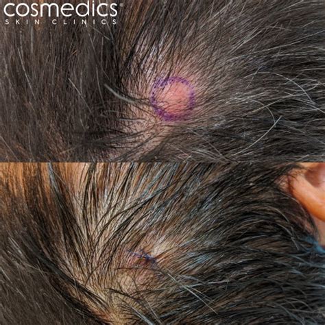 Cyst Removal London Surgical Treatment | Cosmedics Skin Clinics