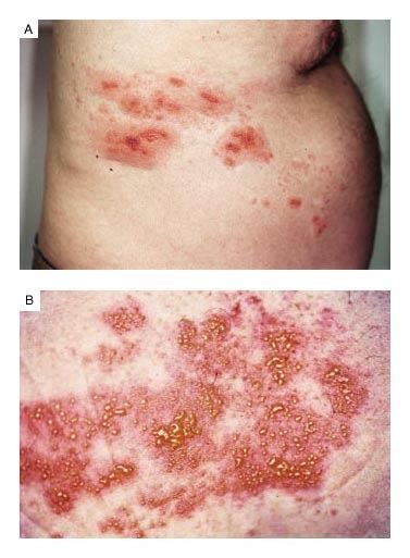 Dermatome Map Shingles Leg