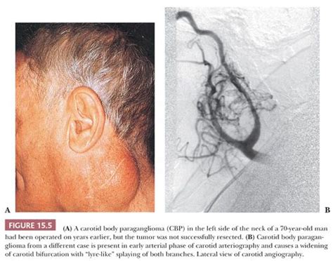 Paraganglioma: การวินิจฉัยและการรักษา - MedThai