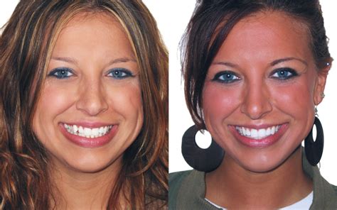 Incredible Adult Braces Before and After Comparisons