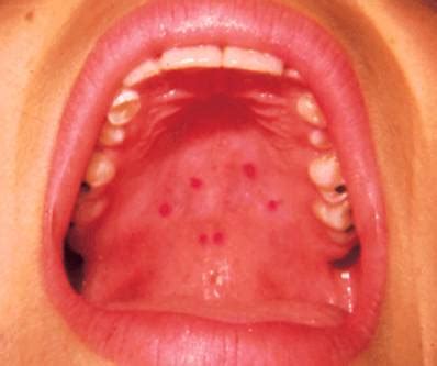 What Causes Red Spots on Roof of Mouth | UtoDent.com