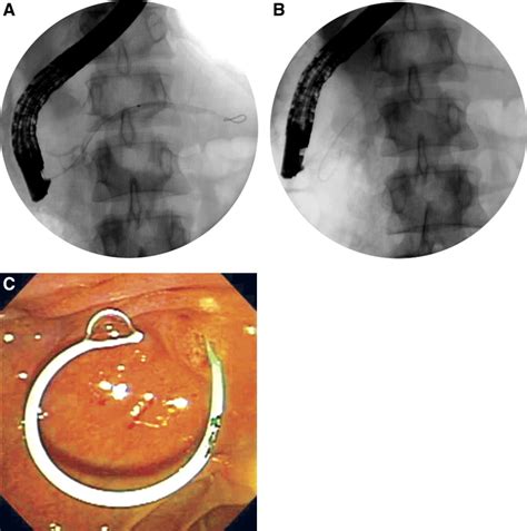 Pancreatic Stents for Prevention of Post–Endoscopic Retrograde ...