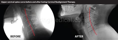 Cervical Kyphosis Exercises