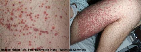 Petechiae: Causes, Symptoms and Treatments (Including Images)