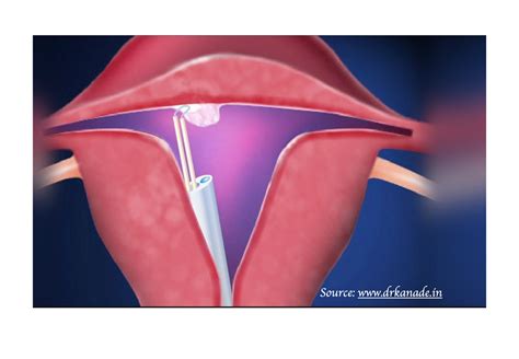 Uterine Fibroid Embolisation and Other Fibroid Treatments | Sydney Fibroid Clinic