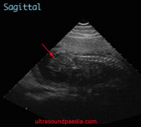 Sacrococcygeal teratoma – ULTRASOUNDPAEDIA