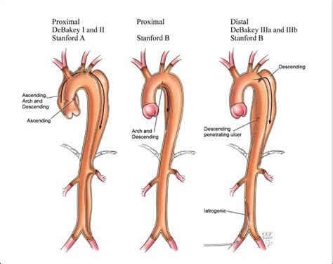 Dacron graft repair of ascending and descending aortic dissection ...