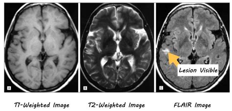 Neuroimaging as a Tool for Diagnosing and Tracking Multiple Sclerosis — BrainPost | Easy-to-read ...