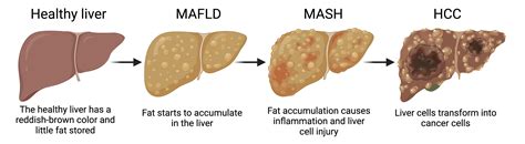 Novel treatment strategies for fatty liver-related cancer – reality or ...