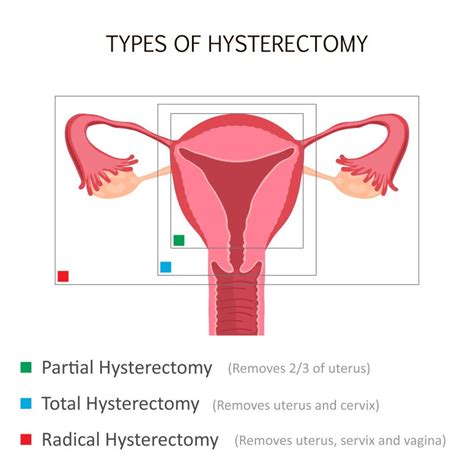 Hysterectomy - Cherokee Women's Health