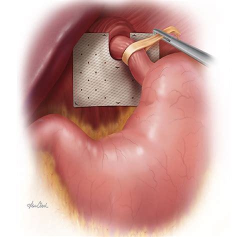 Biodesign Hiatal Hernia Graft – H&R Healthcare