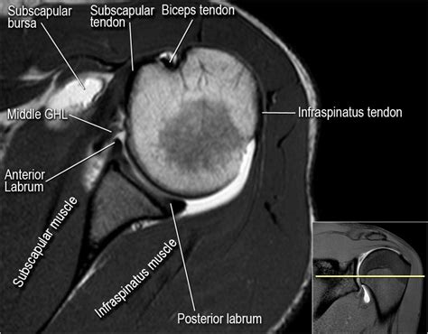 The Radiology Assistant : Shoulder MR - Anatomy