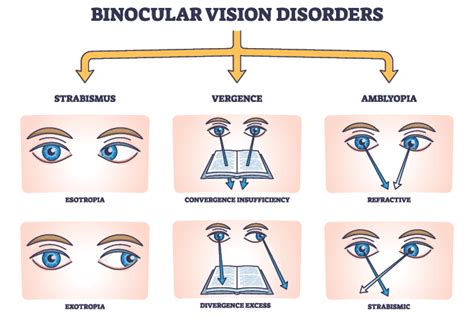 What Is Binocular Vision (Eye Teaming)?