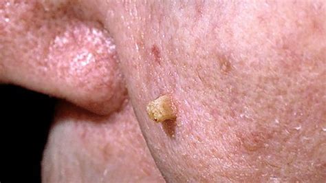 Can Rashes Be a Sign of Cancer? Itchiness and Symptoms