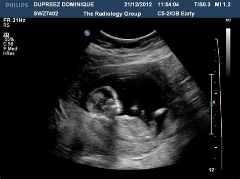 13 Week Pregnancy Ultrasound - YouTube