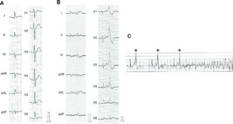 A: Twelve-lead electrocardiogram (ECG) at baseline. The J waves were ...