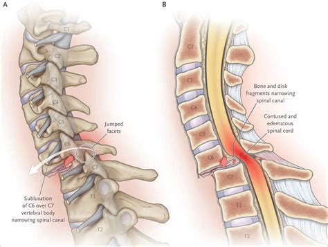Multilevel thoracic spondylosis: What Is Multilevel Spondylosis? Exploring Cervical & Lumbar