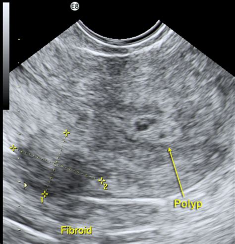 Chapter 6 – Endometrial polyps – Melaka Fertility