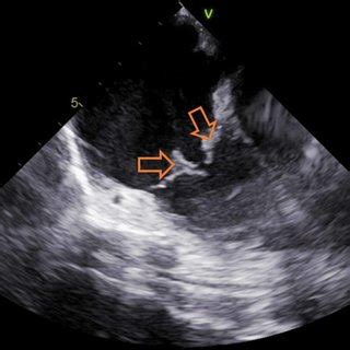 Postprocedure transesophageal echocardiogram | Download Scientific Diagram