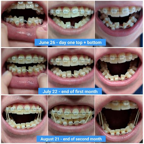 Collection 102+ Pictures Braces Month By Month Progress Pictures Sharp 10/2023