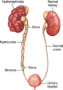 HYDRONEPHROSIS Nursing Study, Nursing Notes, Medical School Interview, Basic Anatomy And ...