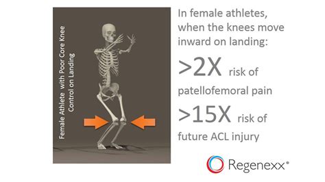 ACL Injury Causes: Girls Who Lack Knee Control are 15X More Likely to Injure Their Knee ACL ...