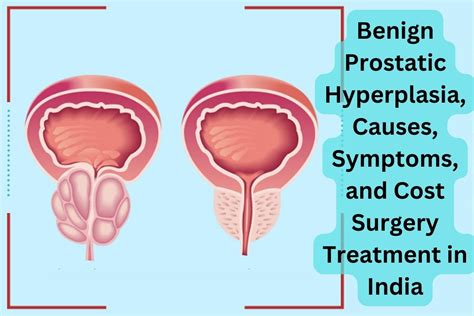 Benign-Prostatic-Hyperplasia-Causes-Symptoms-and-Cost-Surgery-Treatment ...