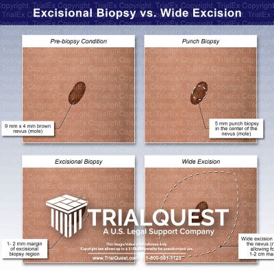 Excisional Biopsy vs Wide Excision - TrialExhibits Inc.