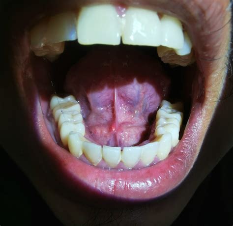 Sialolith: Can a Stone form in my salivary ducts? - Dr. Ruth - Otolaryngology