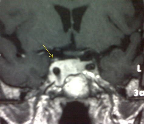 Cavernous Haemangioma of Cavernous Sinus-MRI - Sumer's Radiology Blog