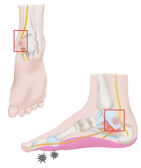 Tarsal Tunnel Syndrome | Spine Specialist | Vail, Aspen, Denver CO