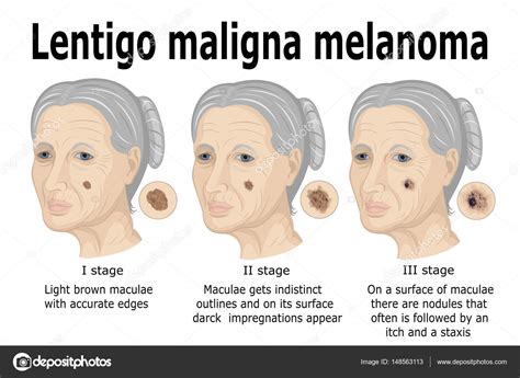 Lentigo Maligna Melanoma Histology