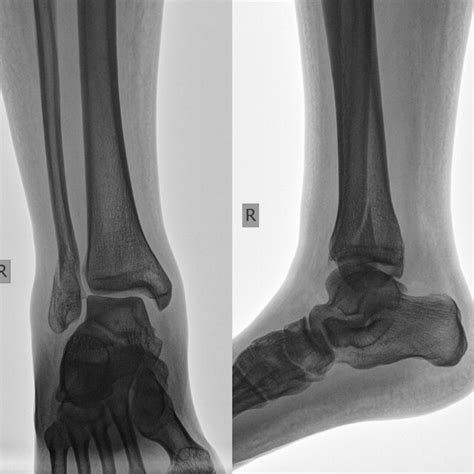 a. X-rays of bimalleolar fracture (+Vohlkmann's fragment) before ...