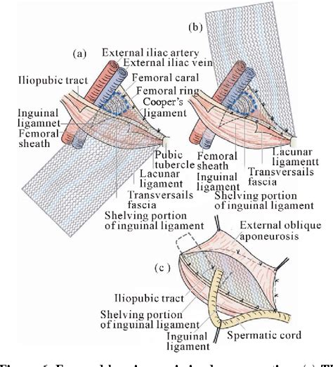 Surgical Anatomy Of Inguinal And Femoral Hernia Repair Lindisfarne | Images and Photos finder