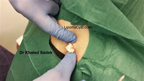 Back Cyst Removal Dr Khaled Sadek Lipomacyst – Otosection