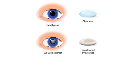 cataract surgery near me cost - Melani Kimbrell