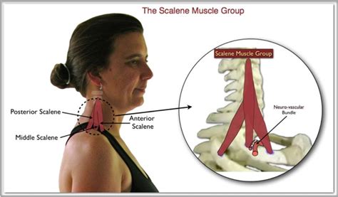 The Scalene Trigger Points: Upper Body Troublemakers | TriggerPointTherapist.com