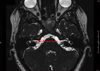 Normal and pathological findings for the facial nerve on magnetic resonance imaging - Clinical ...