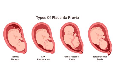 Placenta Previa: Symptoms, Causes And Treatment - Being The Parent