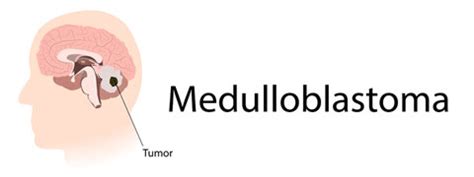 Medulloblastoma: Causes, Symptoms And Treatment