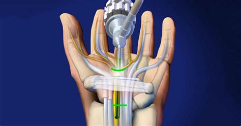 Endoscopic Carpal Tunnel Release Surgery - Brandon P. Donnelly