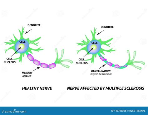 The Destruction of the Myelin Sheath on the Axon. Damaged Myelin. Neuron Affected by Multiple ...