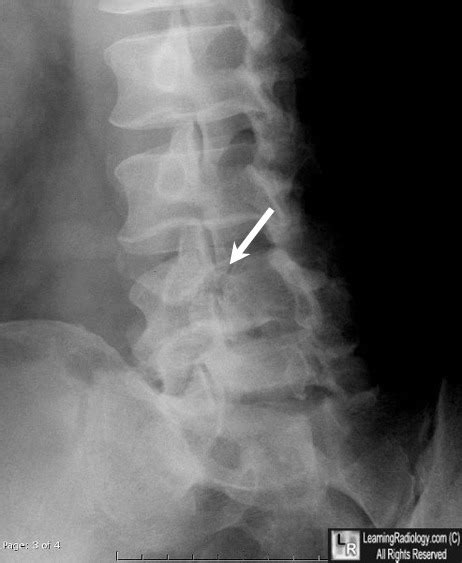 Learning Radiology - Spondylolysis