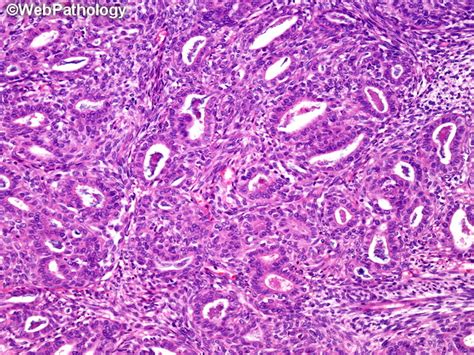 Webpathology.com: A Collection of Surgical Pathology Images