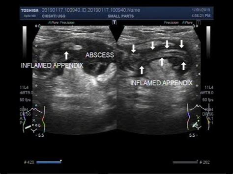 Ultrasound Video showing inflamed appendix with Appendicular abscess. - YouTube