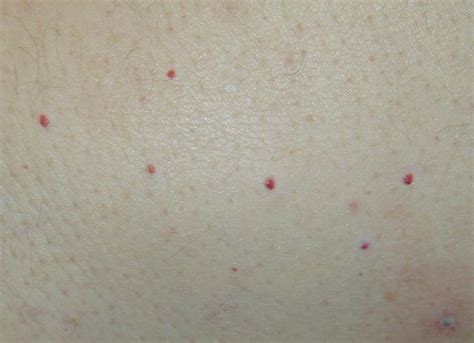 How to Treat Dots, Bumps and Red Spots On Skin | Skin spots, Dots, Red dots