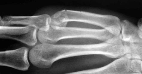 Metacarpal Fractures - Hand - Orthobullets